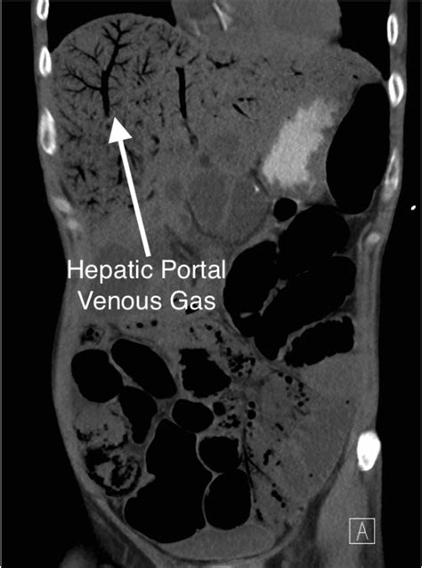 Gas In Hepatic Flexure at Susan Mcdaniel blog