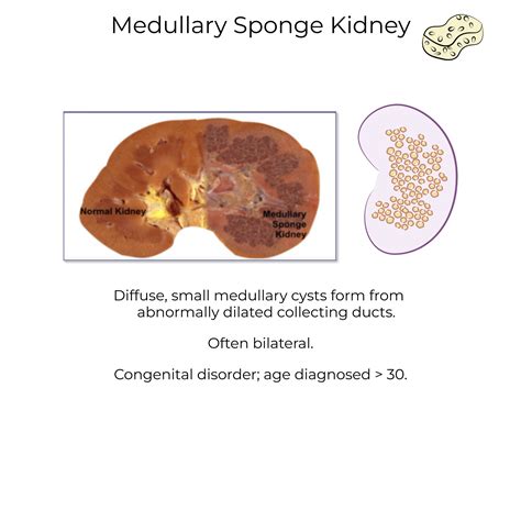 Medullary Sponge Kidney Disease Stones