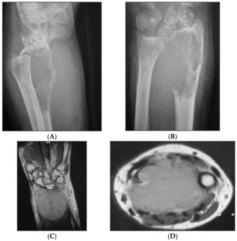 Outcomes of Free Vascularized Fibular Grafts in Treating Massive ...
