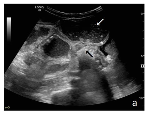 Ultrasound of Small Bowel Obstruction: A Pictorial Review