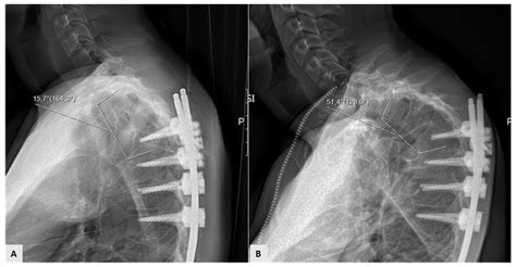 Mechanical Complications in Adult Spine Deformity Surgery ...