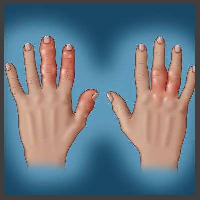 homeopathic treatment for Psoriatic arthritis in homeopathy, Psoriatic ...