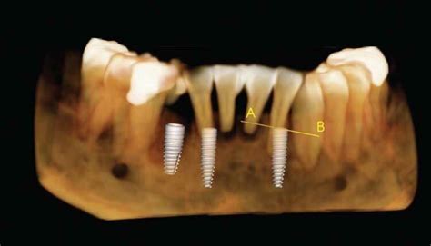 AI-based segmentation of implants and crowns can improve pre-surgical ...