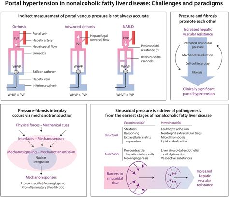 Portal Hypertension in Nonalcoholic Fatty Liver Disease: Challenges and Paradigms