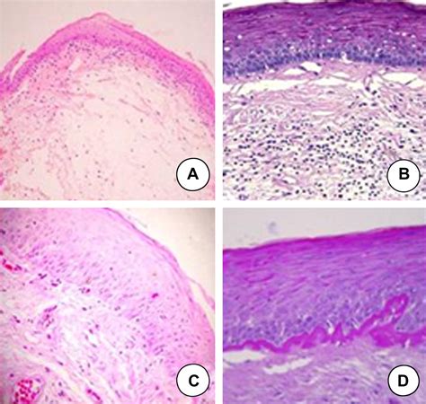 Reinke's Edema Of Vocal Cords at Abigail Chambers blog