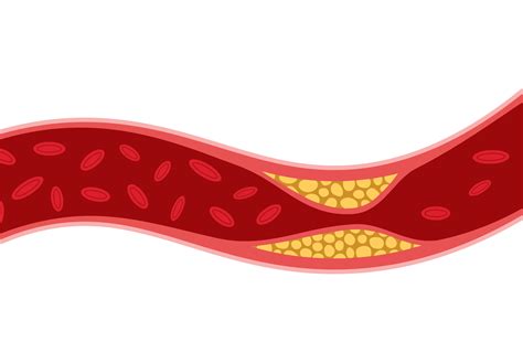 Peripheral Artery Disease vs. Peripheral Vascular Disease: What’s the ...