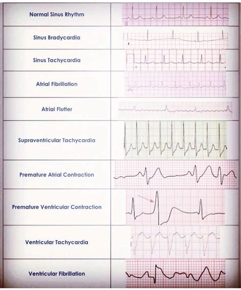 Printable Ekg Cheat Sheet