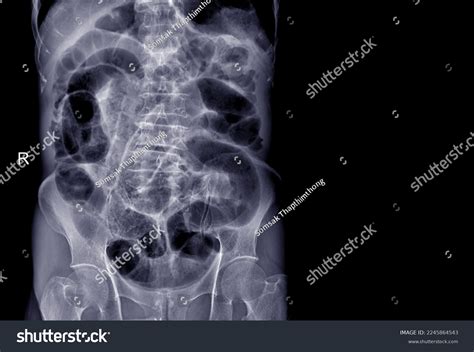 X-ray Patients Stomach Showing Gas Intestines Stock Photo 2245864543 | Shutterstock