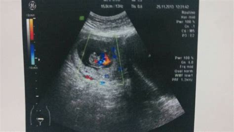 请各位医生朋友帮我看看这个bc,怀孕十周的 大小约46*35*49mm,胚芽长29mm.那个彩色区 - 百度宝宝知道