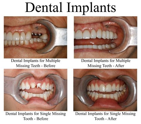 Dental Implants Missing Teeth
