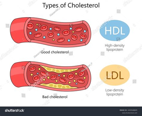 Hdl Good Cholesterol Ldl Bad Cholesterol Stock Illustration 2455546825 ...