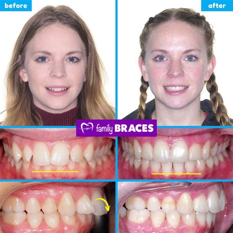 Overbite Correction Before And After Pictures Can Invisalign Fix