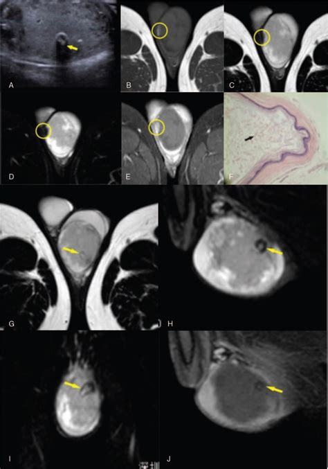 MRI findings of an atypical testicular epidermoid cyst: A ca... : Medicine