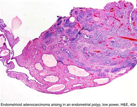 Pathology Outlines - Endometrial polyp