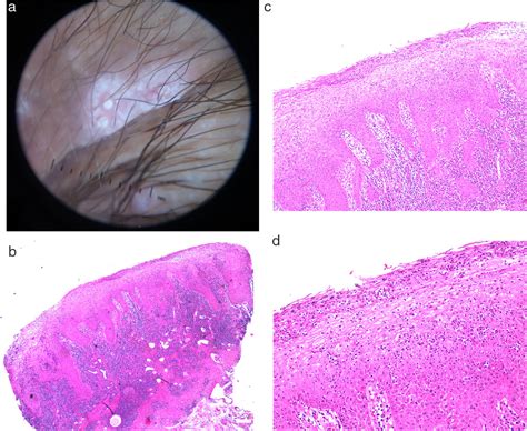 Whitish Dots Provide the Key to Diagnosing Condyloma Lata: A Report of ...
