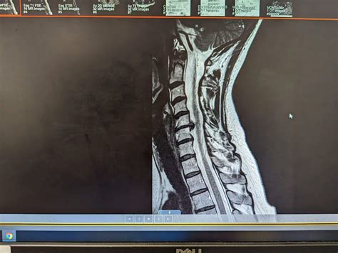 C4-C7 ACDF Fears. Doctors say procedure is high risk. : r/spinalfusion