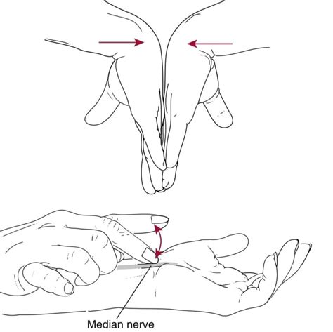 Dr.Gulshan Iqbal Qadri on LinkedIn: Clinical tests for carpal tunnel syndrome(CTS) 1. Phalen ...