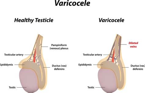 Varicocele & Varicocelectomy (Varicocele Treatment) | University of ...