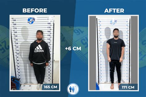 Height Increase Surgery Before After Clearance | centralcountiesservices.org