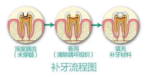 洗牙和牙周刮治有什么区别？ - 知乎