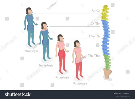 椎麻痺: Over 364 Royalty-Free Licensable Stock Illustrations & Drawings | Shutterstock