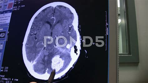 Cat Scan Brain Tumor