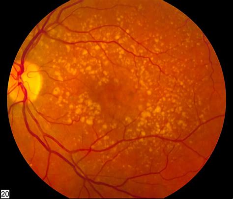 Macular degeneration - Wikipedia