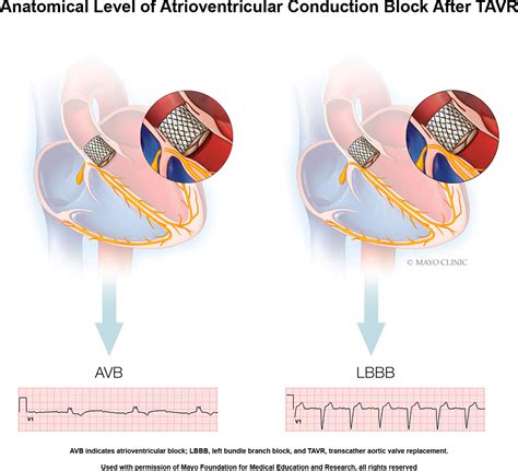 Medical Abbreviation For Avr