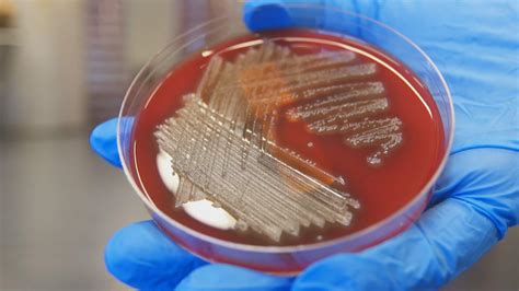 Why deadly, invasive strep A infections are surging in Canada and beyond | CBC News