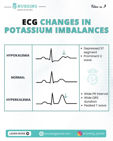 How hyperkalemia affects your heart health | eNursing Portal posted on the topic | LinkedIn