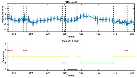 Noise Maps for Quantitative and Clinical Severity Towards Long-Term ECG ...