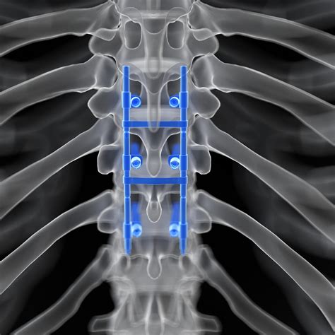 Benefits Of Spinal Fusion | New Jersey | Comprehensive Spine Care