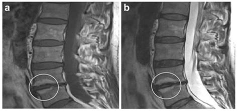 Imaging Evaluation of Intervertebral Disc Degeneration and Painful Discs—Advances and Challenges ...
