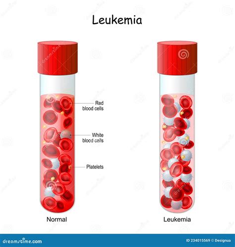 Leukemia. Test Tube With Normal Blood And Blood Cancer Cartoon Vector | CartoonDealer.com #234015569