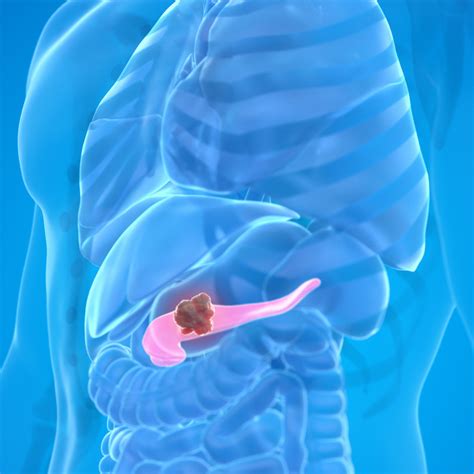 Exocrine Pancreatic Insufficiency (EPI) | FOMAT Medical