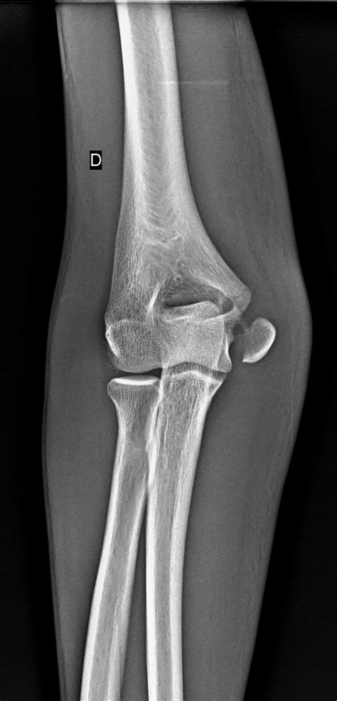 Avulsion Fracture Epicondyle at Alfredo Montano blog