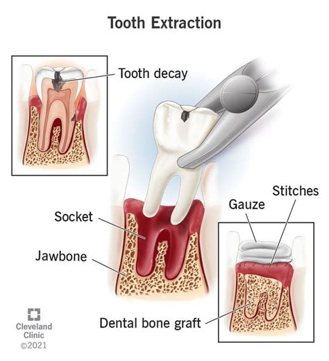 Image result for Tooth Extraction Procedure