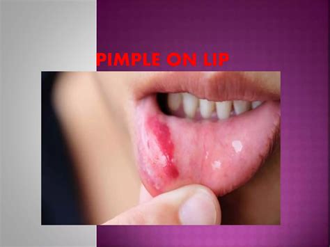 Image result for Pimple From Dry Lips