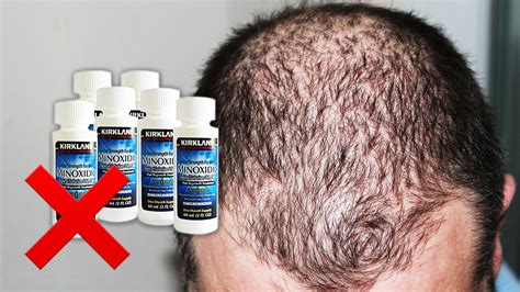 Alopecia Rogaine