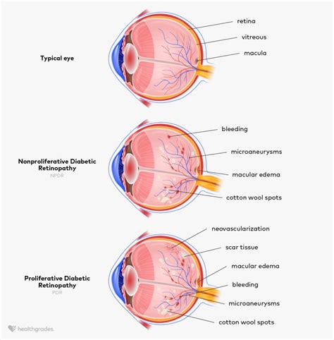 Nonproliferative Diabetic Retinopathy: Symptoms, Causes, Care