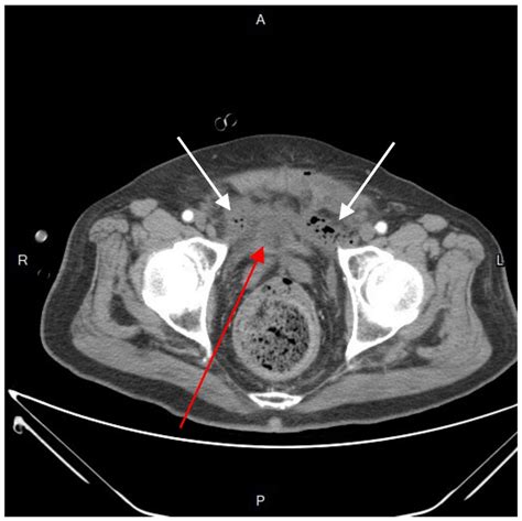 Perirectal Abscess with Anterior Extension to the Extraperitoneum and ...
