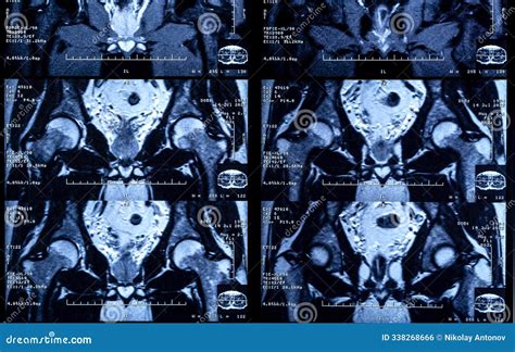 MRI Magnetic Resonance Scan Image of the Hip Joint Stock Photo - Image of film, white: 338268666