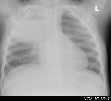 Pneumonia in Children | IntechOpen