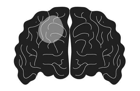 Image result for Obstructive Sleep Apnea