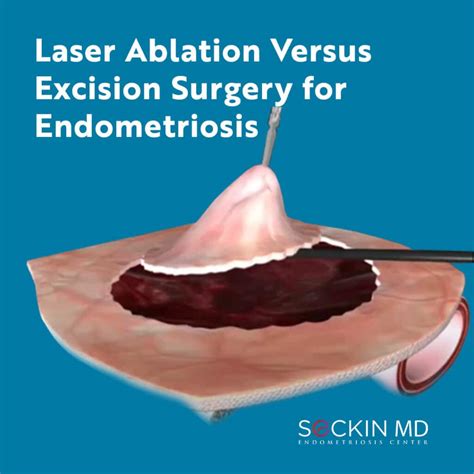 Laser Ablation Versus Excision Surgery for Endometriosis