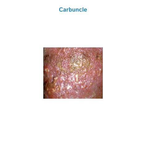 Image result for Removing Carbuncle