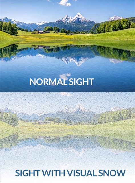 Image result for Visual Snow Simulator