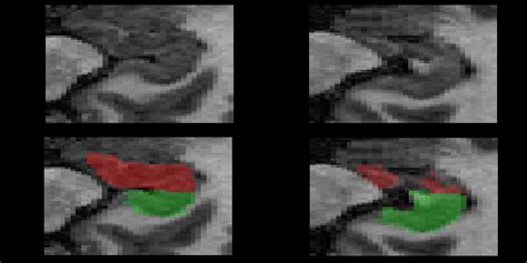 Image result for Decathlon Brain Segmentation Code