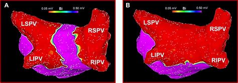 Pulmonary Vein Isolation With and Without Posterior Wall Isolation in ...