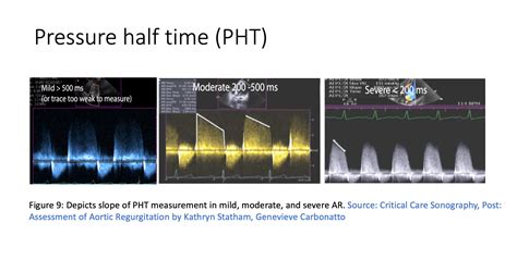 Image result for Pulse Pressure Variation EMCrit